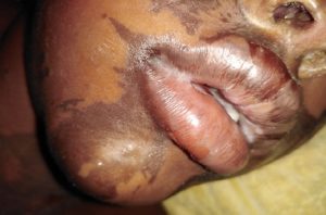 Niña de 6 años delicada al ser rociada con 