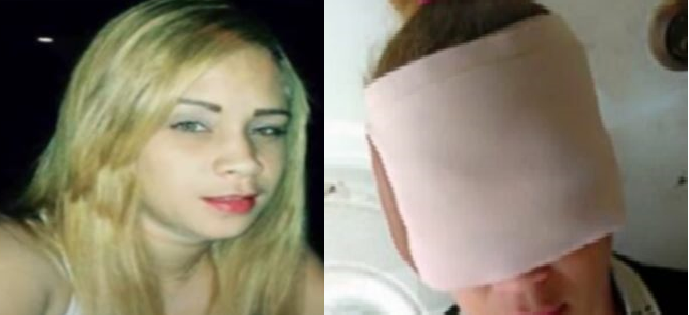 Otra vez! Joven es atacada con ácido de batería y cloro en Higüey