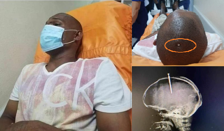 Fallece en hospital de Santiago joven de Puerto Plata se clavó un clavo en la cabeza 