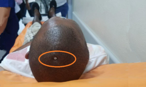Hecho insólito en Puerto Plata! Hombre drogado se clava un clavo en la cabeza 