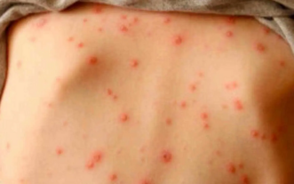 Autoridades Salud Pública emiten alerta epidemiológica por sarampión; aclara hasta ahora se no se ha reportado casos