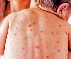 Aparecen en NYC primeros casos de sarampión