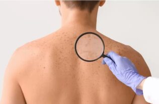 Primera infección por hongos transmisión sexual en USA; contagiado es de NY