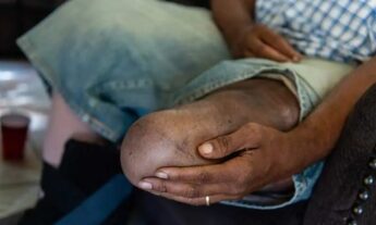 Alarma a dominicanos cada 30 segundos amputan extremidad por diabetes en el mundo; El Bronx entre lugares con más casos