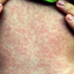 Sarampión se dispara en EUA; primer caso en NYC de virus Chikungunya