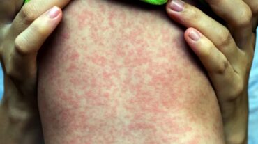 Sarampión se dispara en EUA; primer caso en NYC de virus Chikungunya