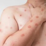 Rara enfermedad en NYC con 8.5 millones de habitantes; entre ellos 900 mil dominicanos