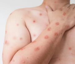 Rara enfermedad en NYC con 8.5 millones de habitantes; entre ellos 900 mil dominicanos