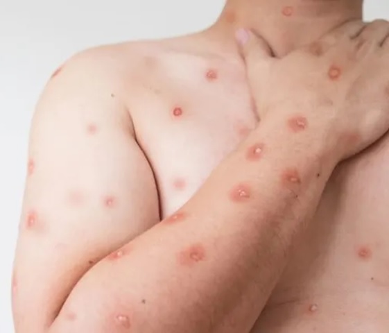 Rara enfermedad en NYC con 8.5 millones de habitantes; entre ellos 900 mil dominicanos