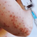 Alarma a dominicanos en NYC aparición del sarampión