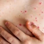 NYC reporta el primer caso de Mpox, una enfermedad infecciosa; emite alerta sanitaria