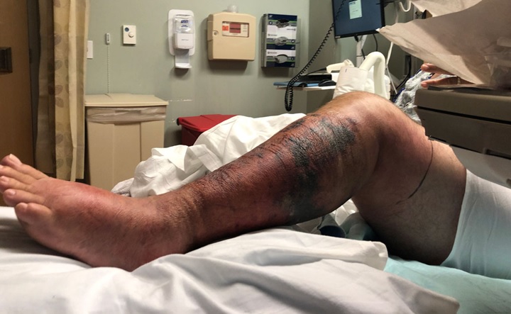 Encuentran bacteria carnívora en aguas Long Island pueden matar personas en 48 horas