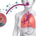 En NYC emergencia sin precedentes por brote Leionella; quien viva, trabaje o visite el área afectada, debe consultar profesional sanitario
